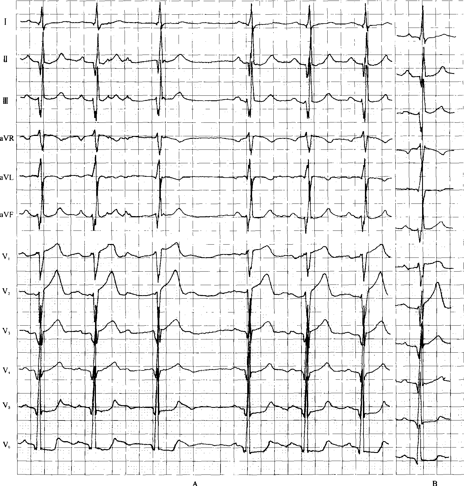 [心电图特征]图a为心绞痛发作时,窦性心律,心率71次/min