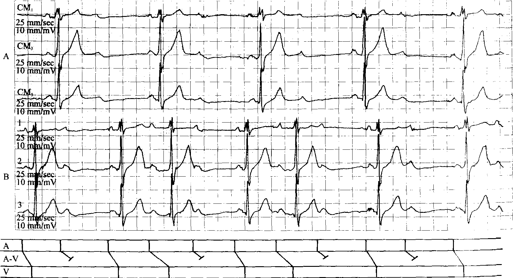 传导阻滞心电图特点图片