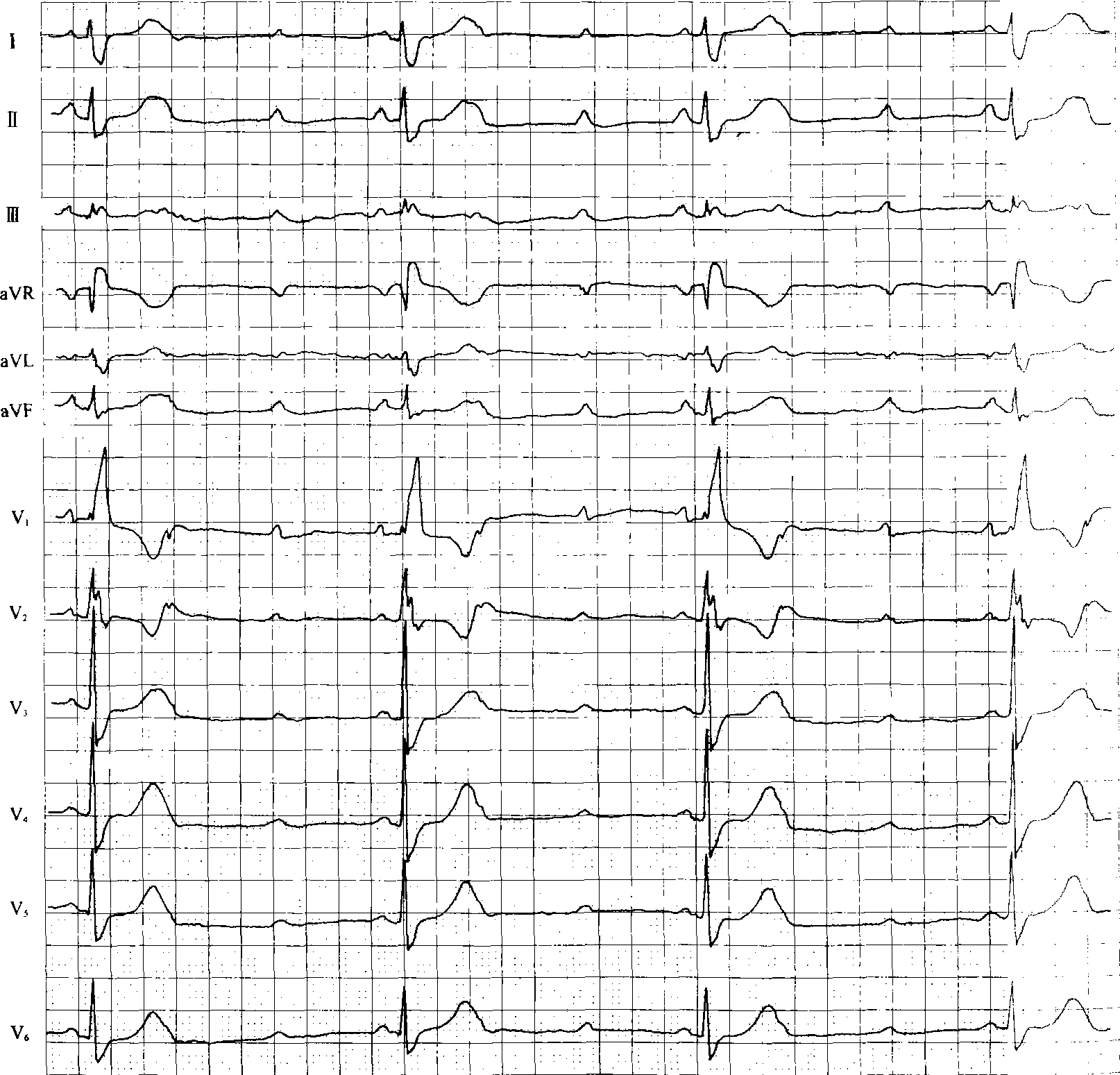 完全性右束支传导阻滞严重吗
