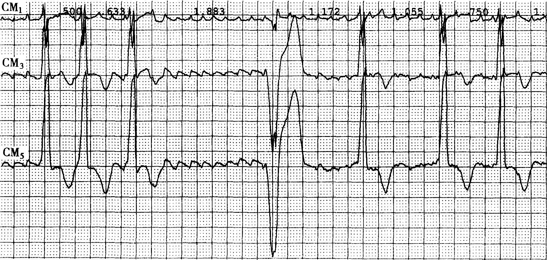 典型的房颤心电图波形图片