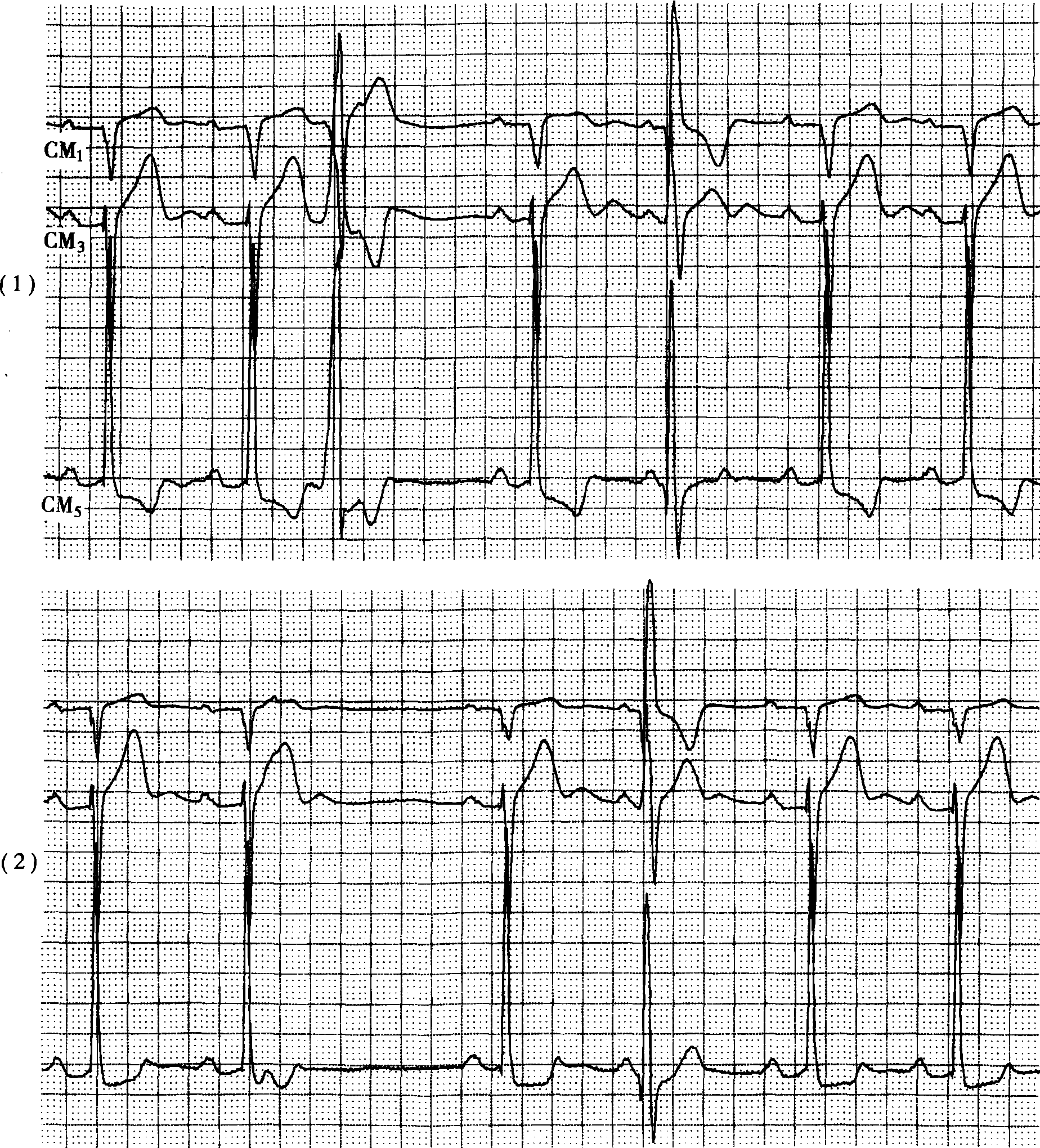 冠心病