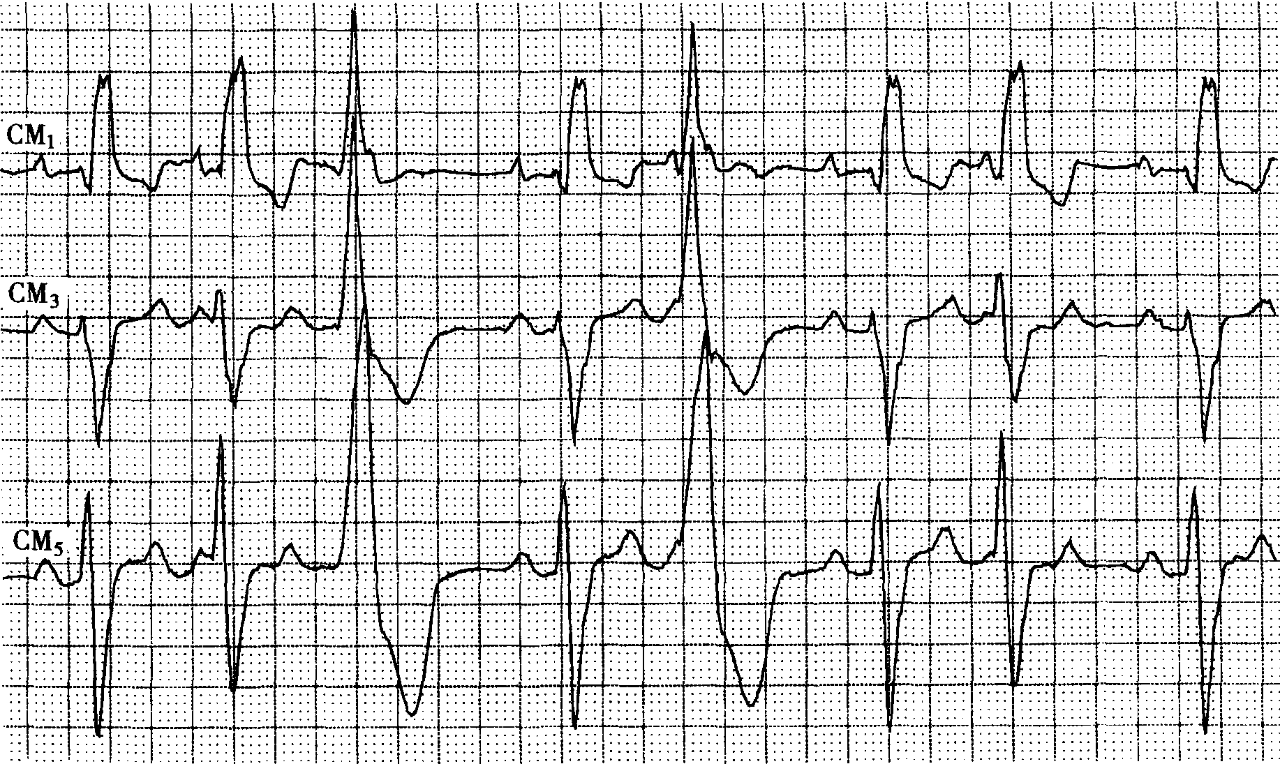 病例640男性52岁扩张性心肌病