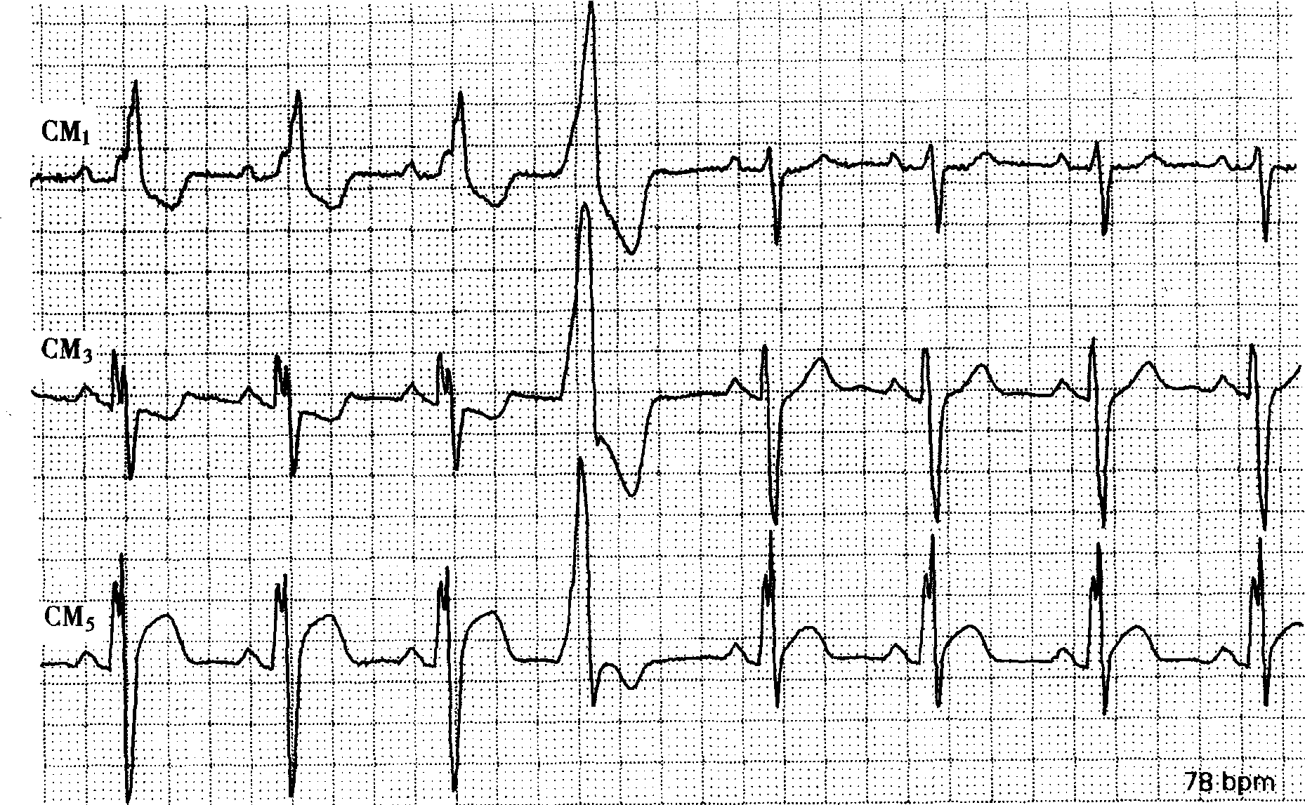 病例686男性60岁扩张性心肌病