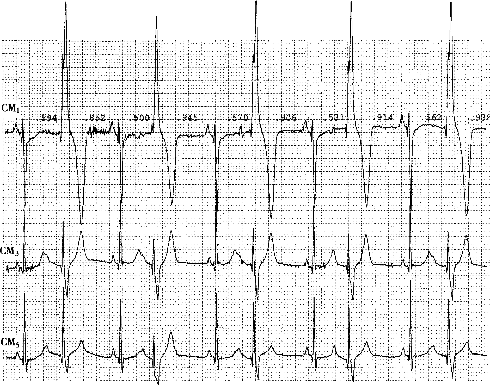 p波高尖的心电图图片