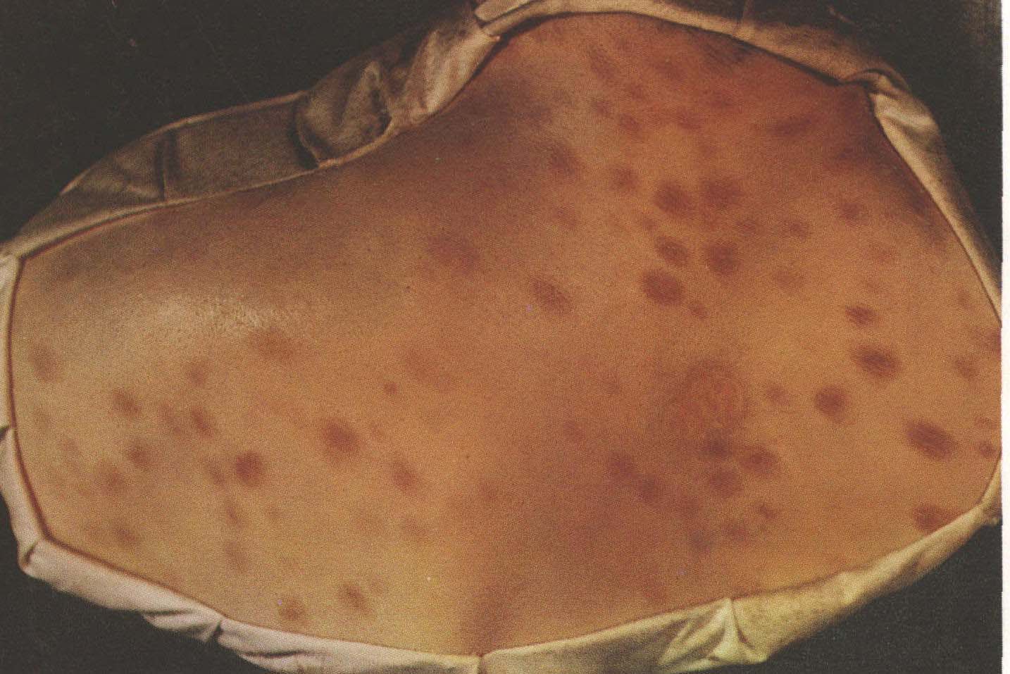 梅花斑疹图片