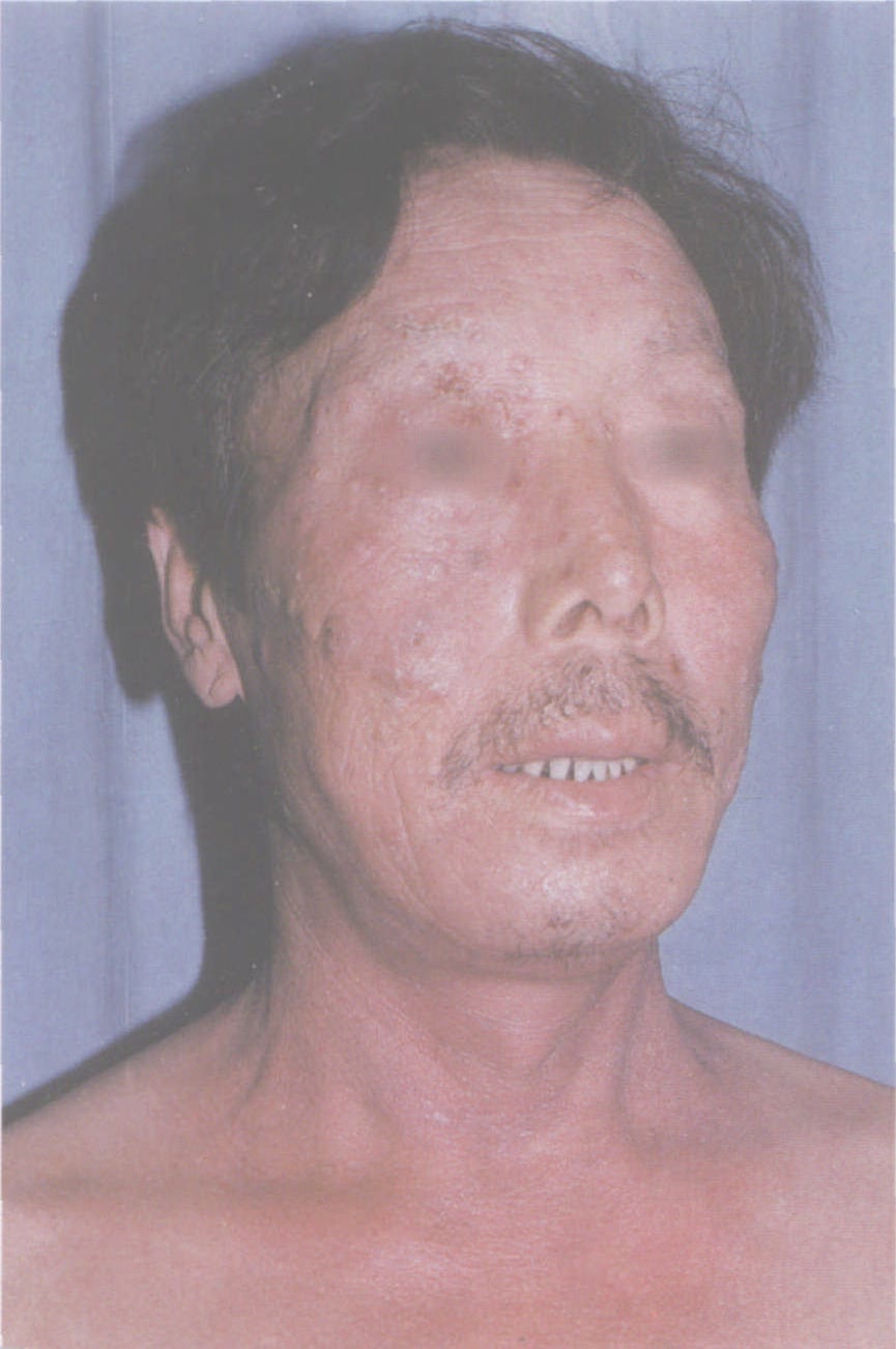 Kaposi’s 水痘樣疹