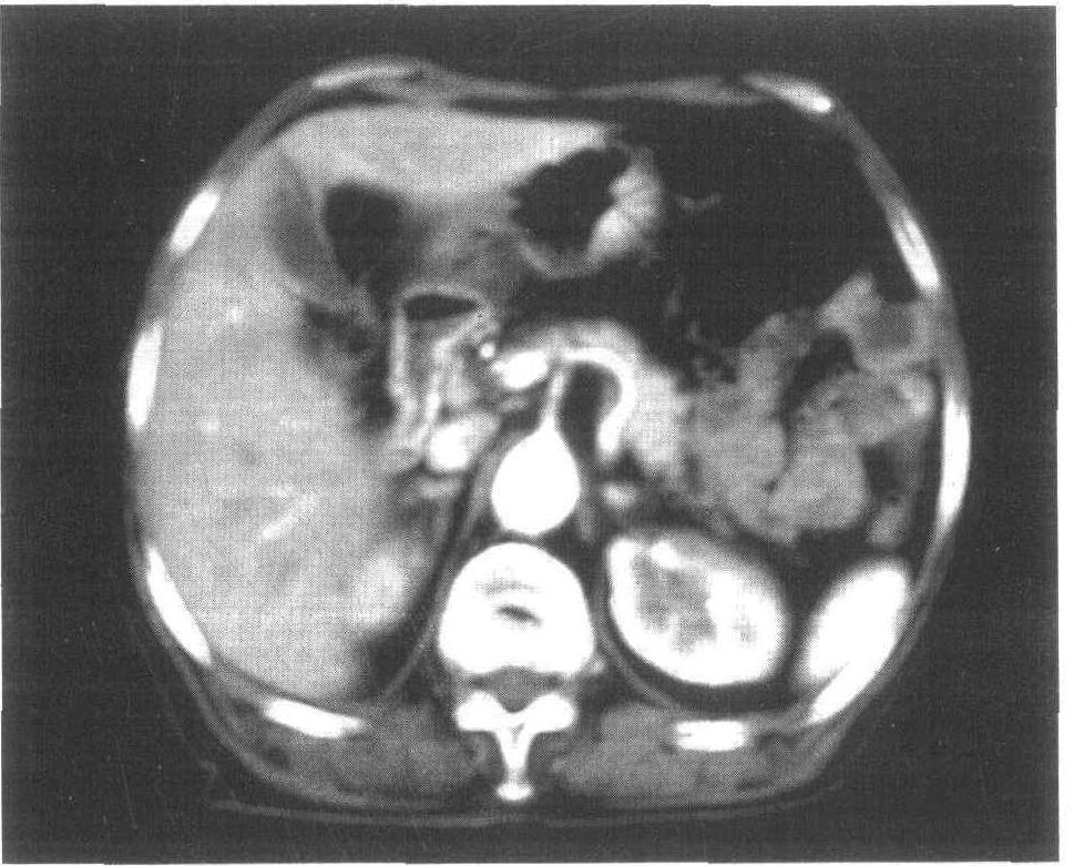 肝脏正常及变异CT图像
