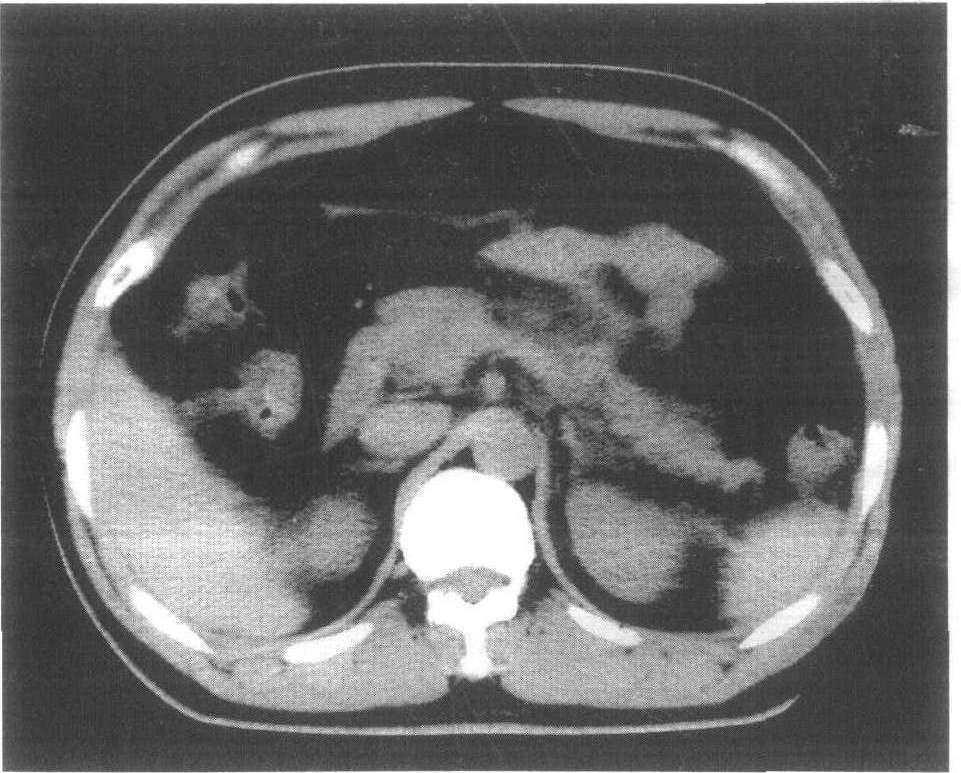 胰腺正常及变异CT图像