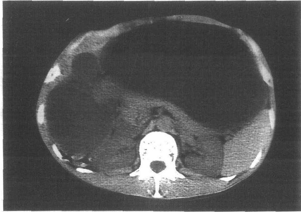 幽门梗阻ct图片