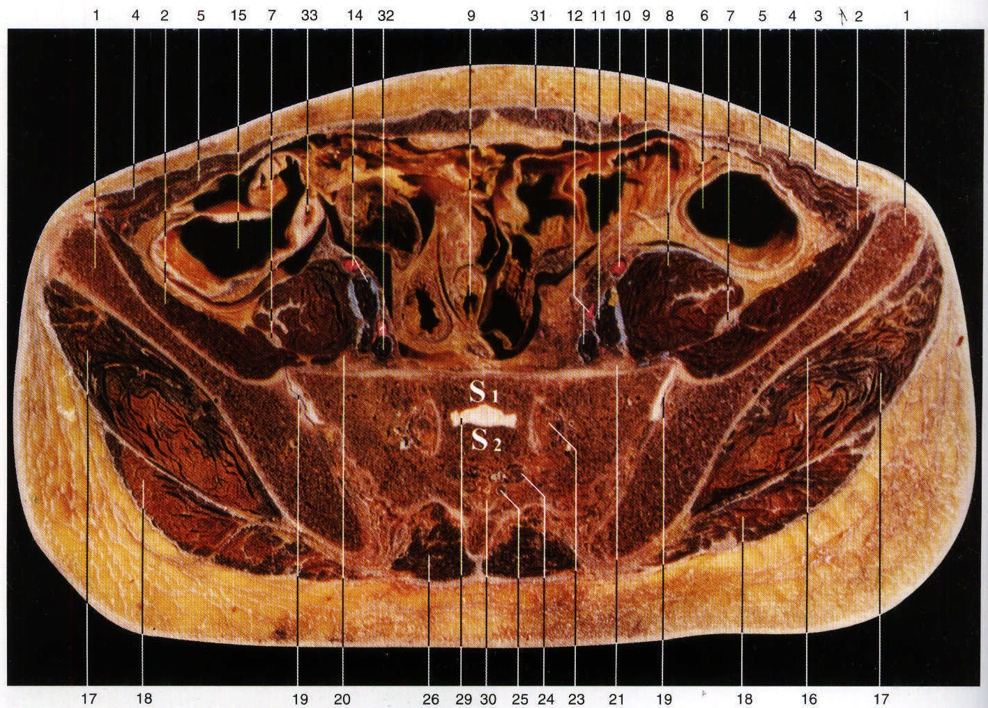 transversus abdominis图片