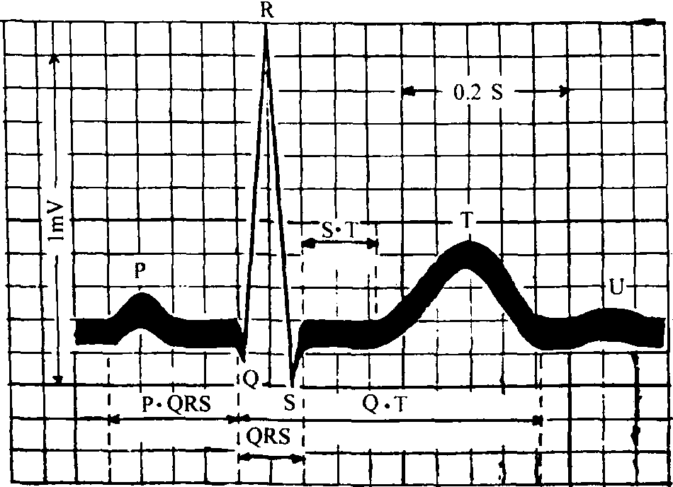 心电图