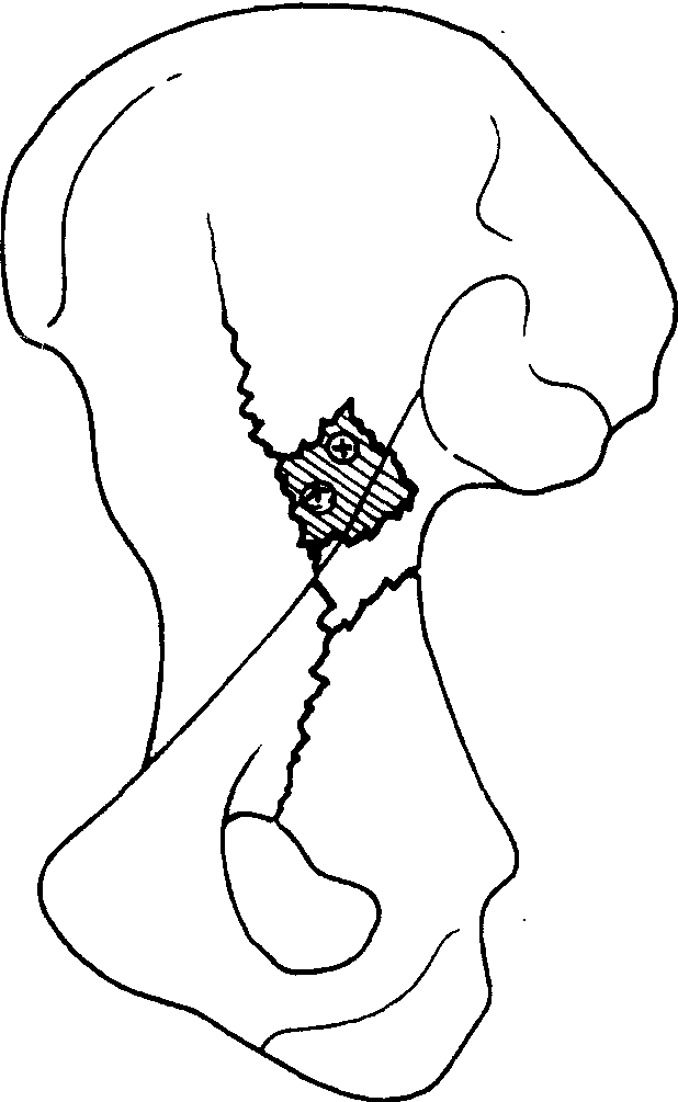 二、經(jīng)髂腹股溝入路行髖臼雙柱骨折內(nèi)固定術(shù)
