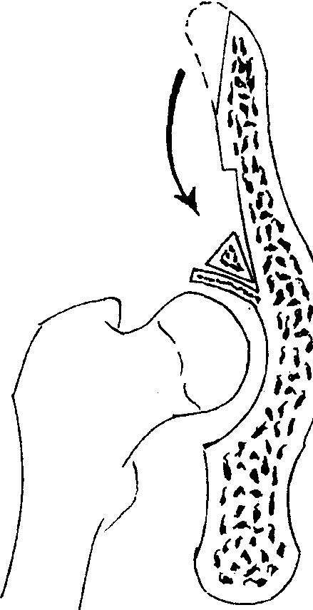 Gill截骨術(shù)