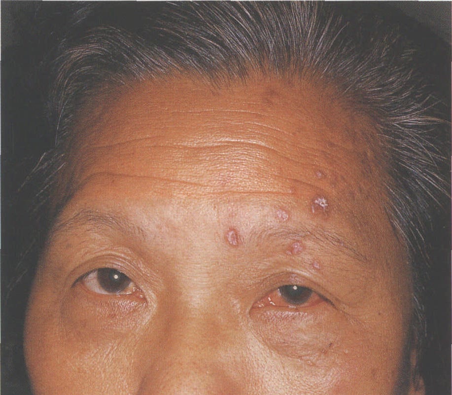 图1-1 带状疱疹性眼病