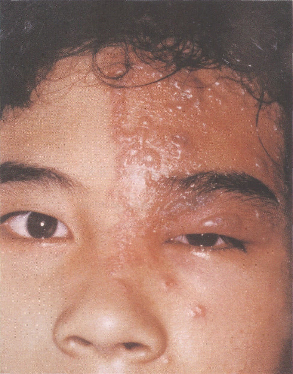 眼睑热性疱疹图片