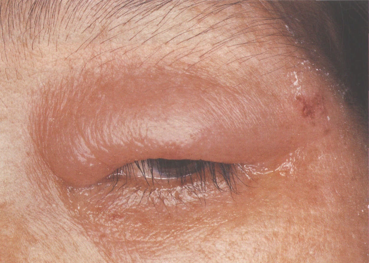 图1-3 变应性眼睑炎。上睑水肿和发红