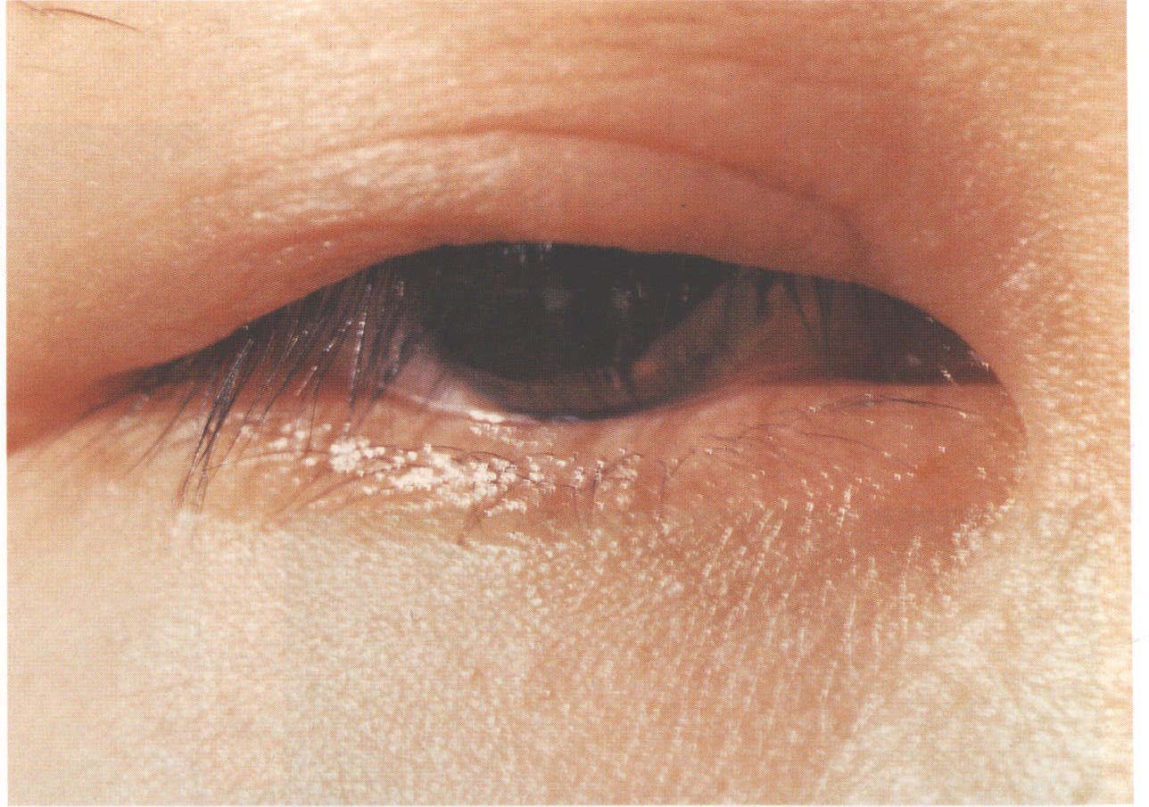 图1-4 变应性眼睑炎。上睑水肿和发红，伴有上睑倒睫