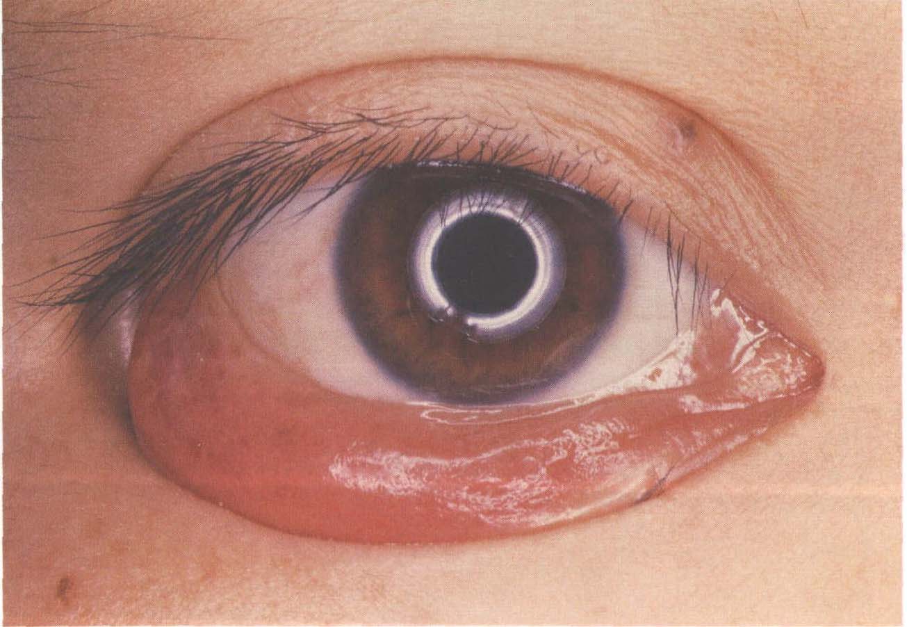 眼肿瘤系列科普——眼皮上长了黄色斑块，是黄色瘤吗？也可能是黄色肉芽肿_眼睑黄色瘤_眼睑黄色瘤治疗方式 - 好大夫在线
