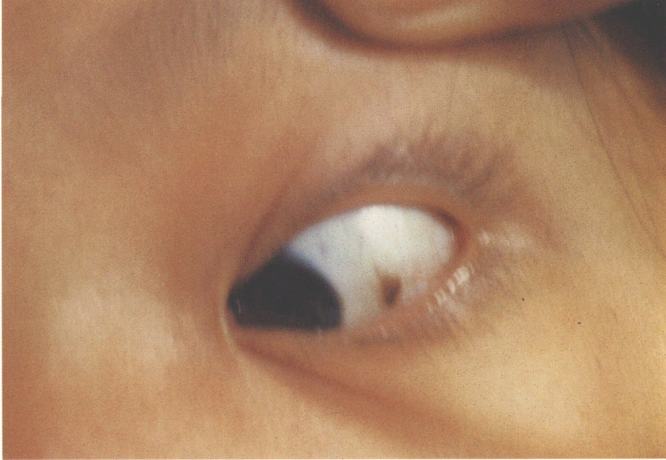 眼结膜色素痣图片