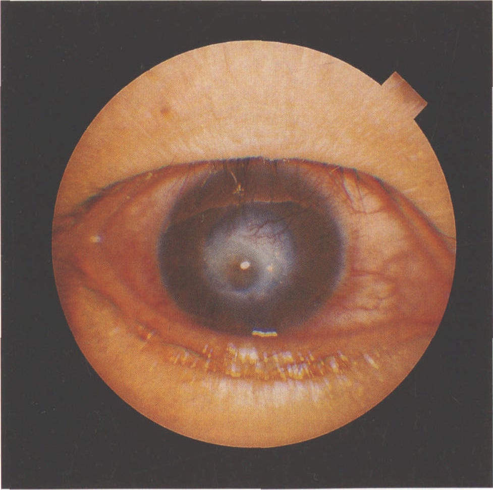 (图) 角膜白斑伴角膜溃疡,角膜新生血管,上睑倒睫