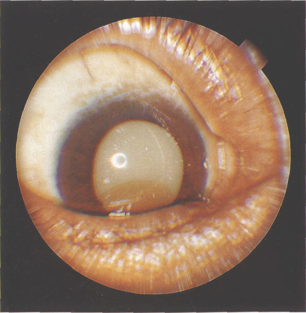 白内障过熟期图片图片