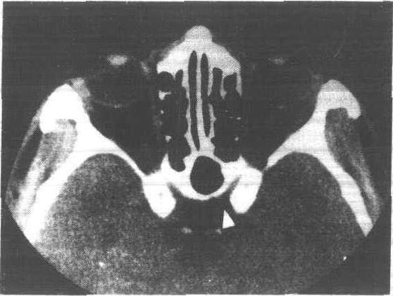 一、正常眼眶骨骼的CT及MRI表現(xiàn)