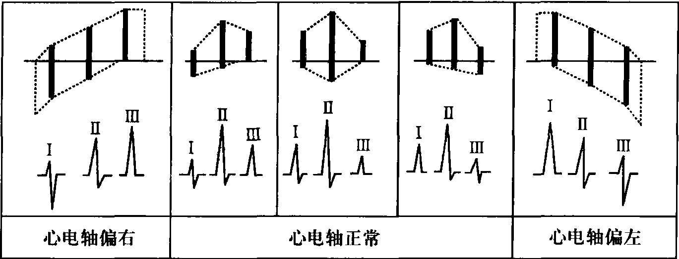 三、從雙極肢導聯(lián)中QRS波的波型確定心電軸