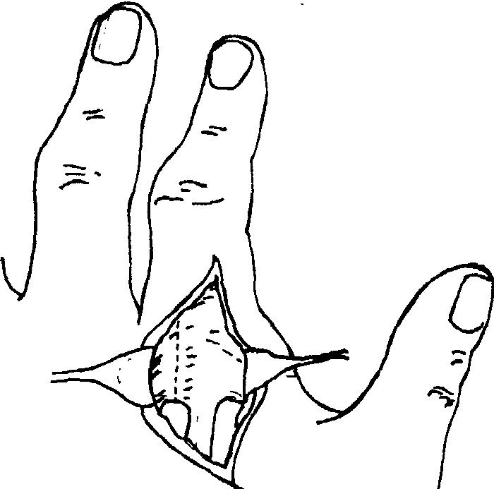 吻合血管的跖趾关节移植掌指关节重建成形术