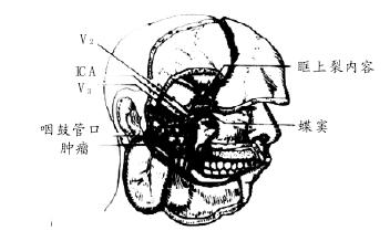 4.翼腭窩及中顱窩底腫瘤面部組織異位進(jìn)路切除術(shù)