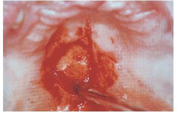 18.腭部小良性腫瘤切除術(shù)