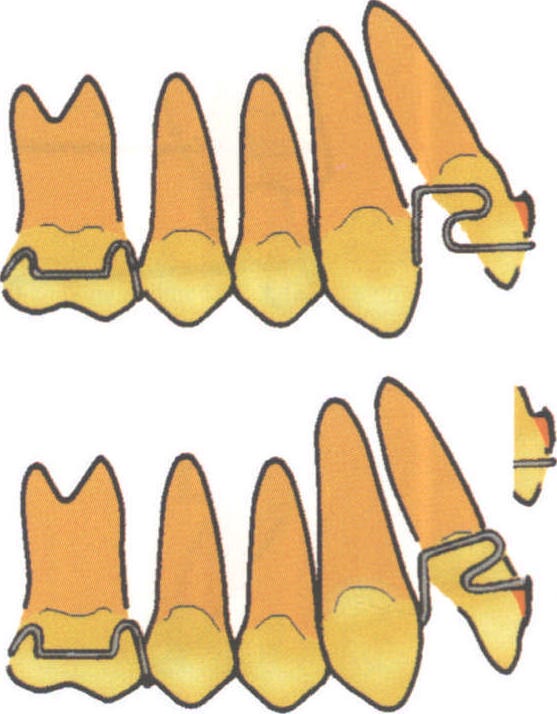 (二)用活动矫治器升高上颌切牙