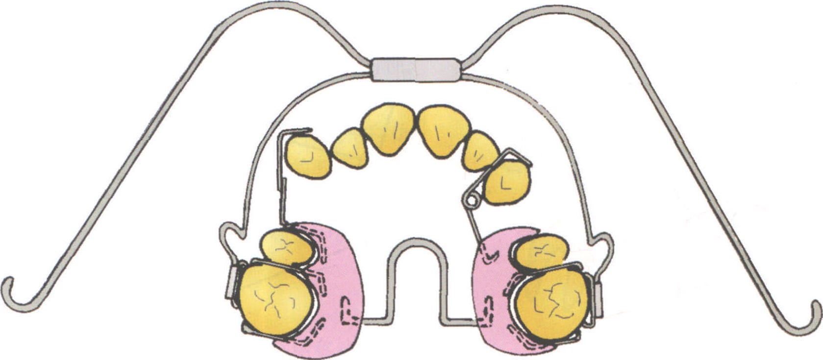 (二)用活动矫治器使上颌尖牙向远中移动