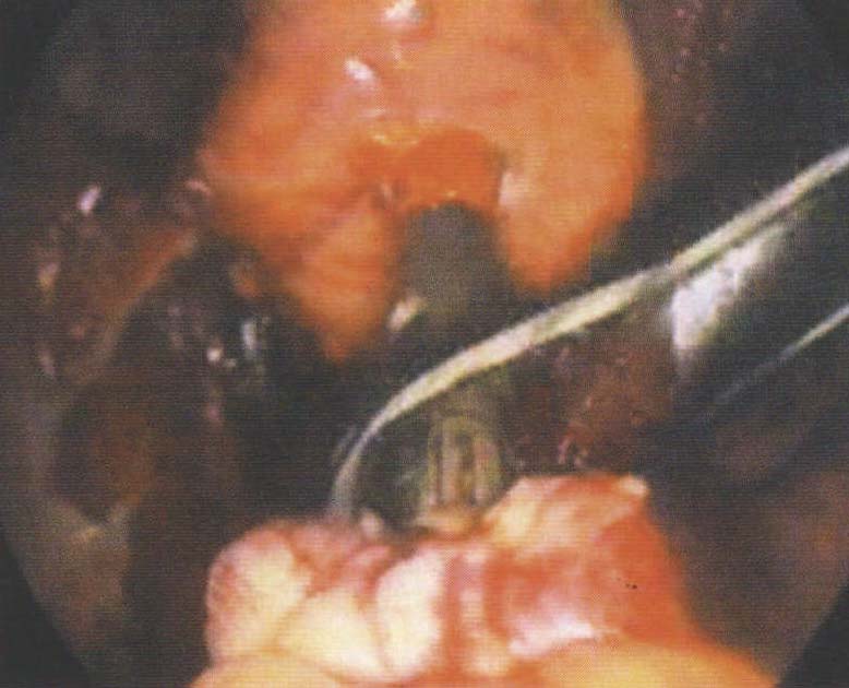 第二節(jié) 腹腔鏡左半結(jié)腸切除術(shù)