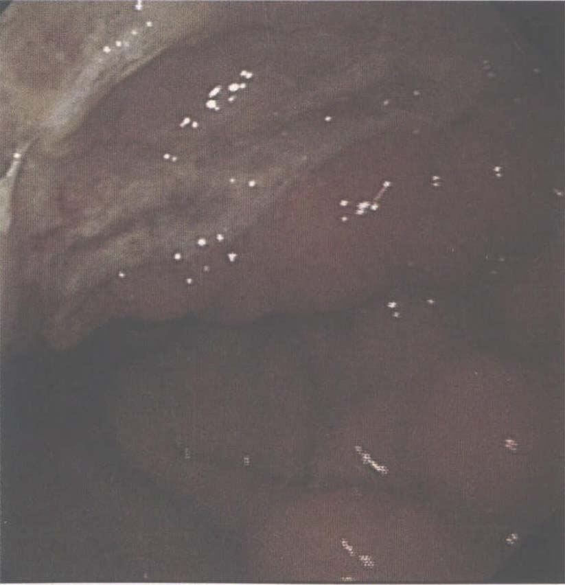 图4-52 胃溃疡 (A1期)