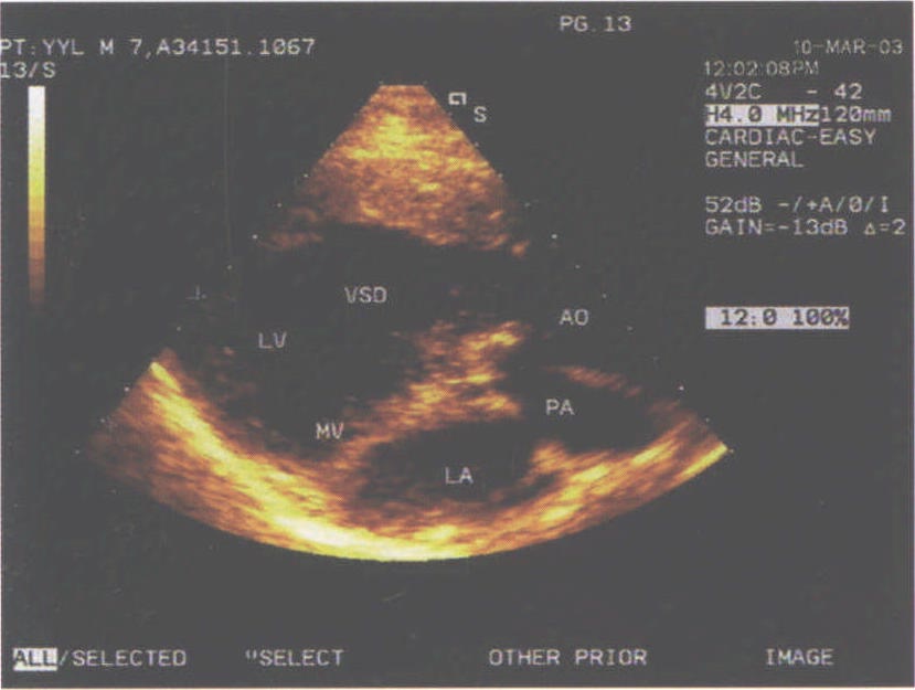 病例2 SDD型完全性大动脉转位合并室间隔缺损、肺动脉瓣狭窄及动脉导管未闭(男7岁)