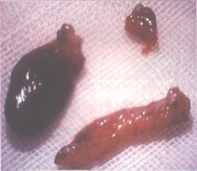 第四節(jié) 宮腔鏡子宮內膜息肉切除術