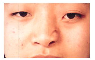 8鼻唇沟皮瓣修复TessierⅢ型面裂鼻翼缺损（图2-3-8-1～图2-3-8-6）