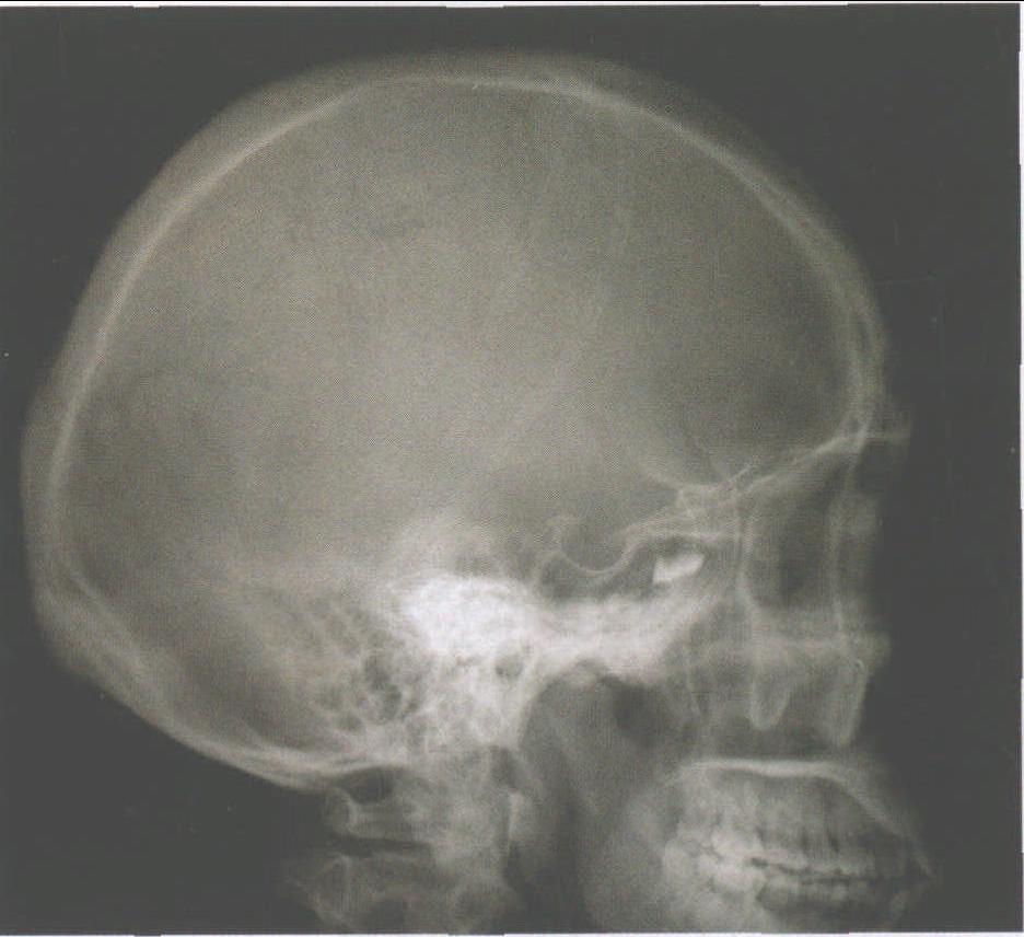 图2-10 颅骨侧位正常X线影像