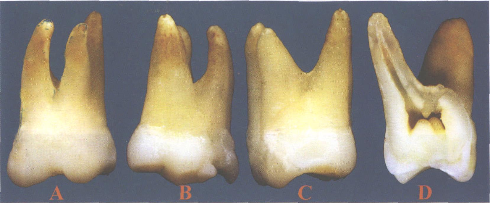 (图) 上颌第一磨牙