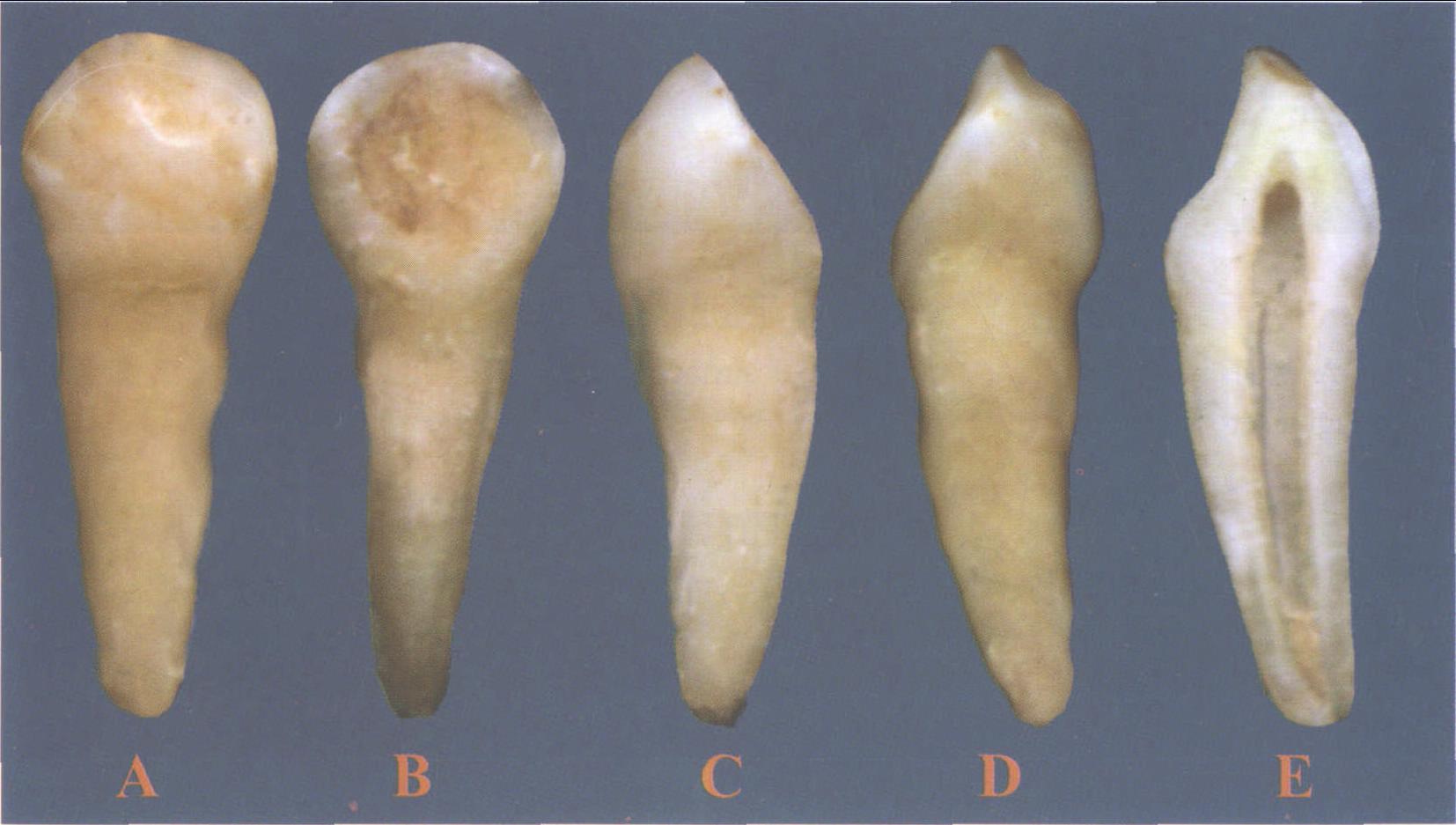 图3-67 下颌乳尖牙