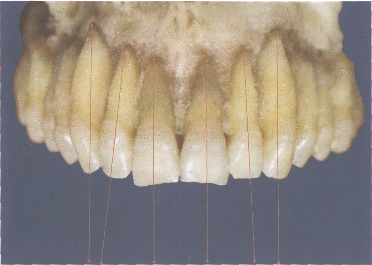 图4-85 上颌切牙、尖牙牙体倾斜前面观