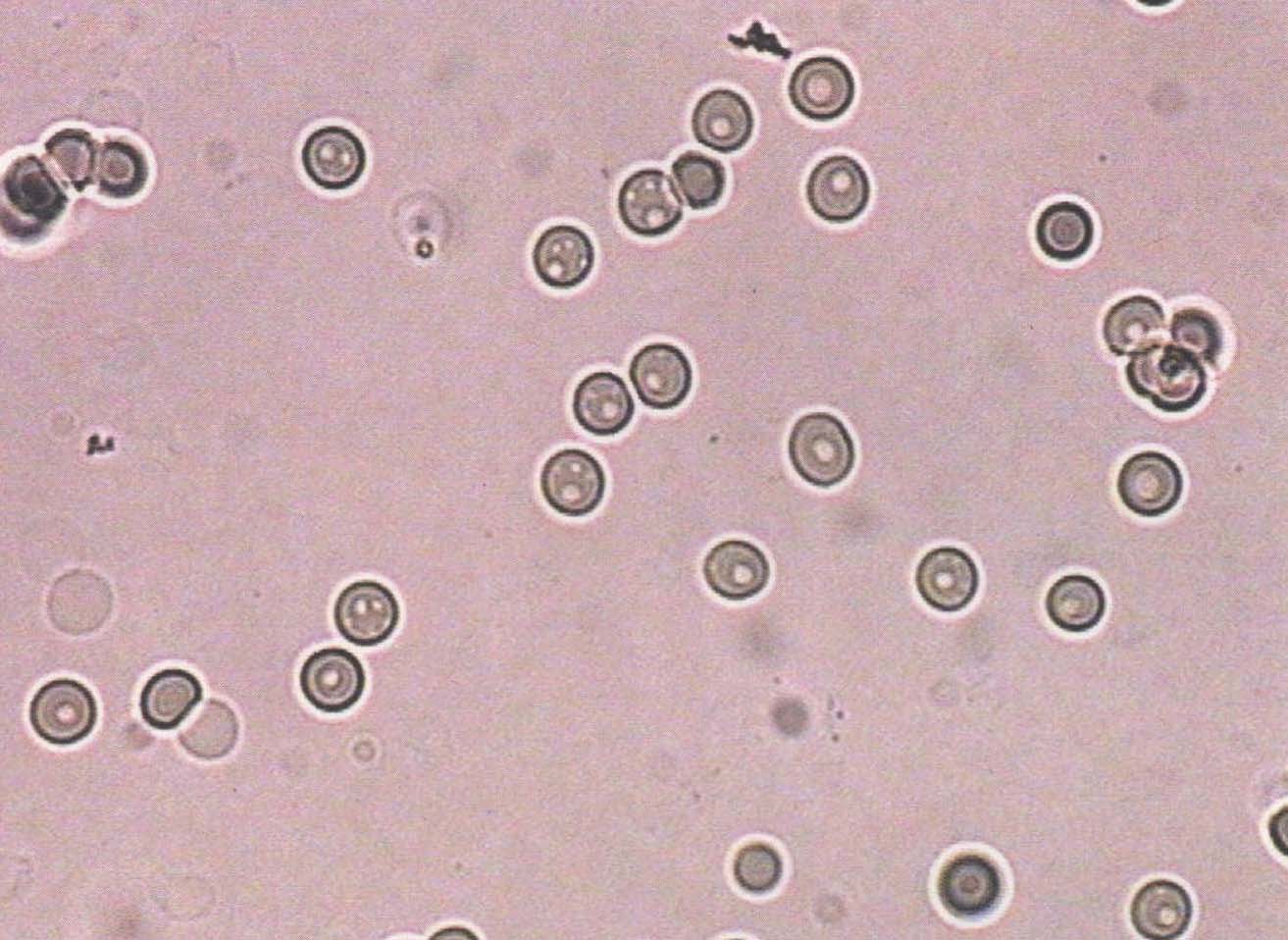 图3-1-20 各种变形红细胞-尿液沉渣实录-医学