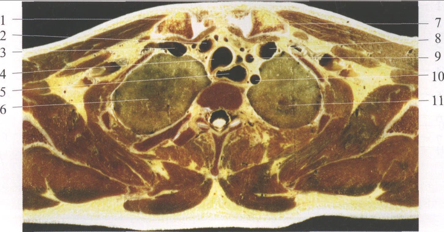 图15-2 经胸骨颈静脉切迹的横断面