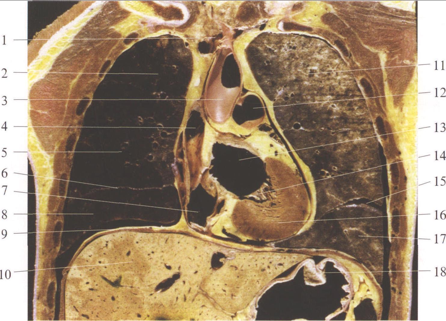 图15-37 经主动脉弓的冠状断面