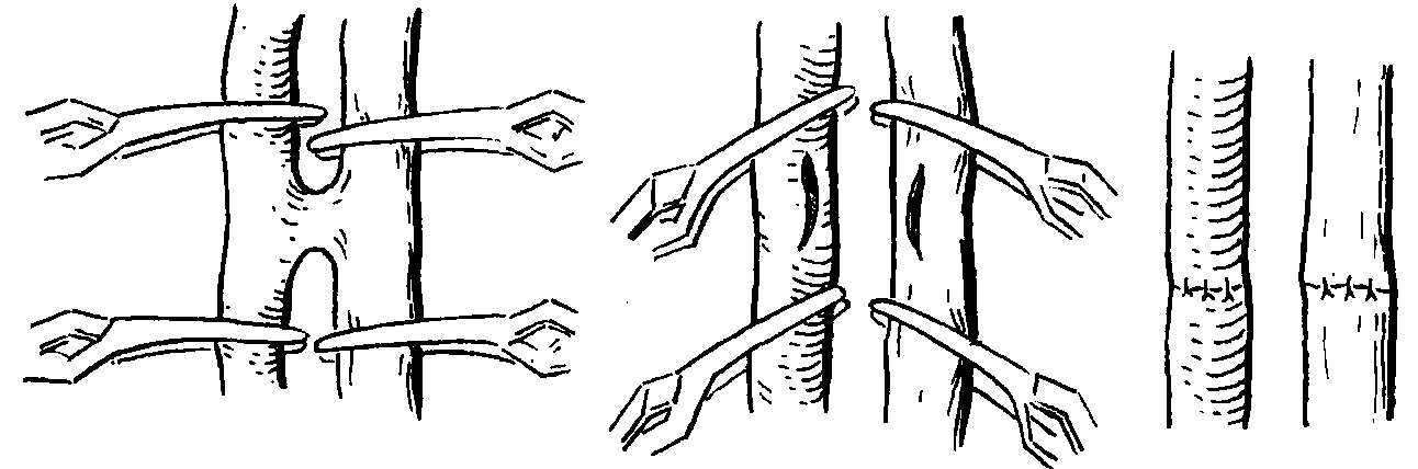 10 后天性動靜脈瘺切除術(shù)