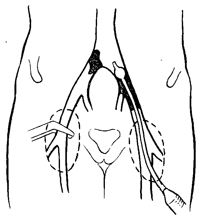 15 動(dòng)脈Fogarty導(dǎo)管取栓術(shù)
