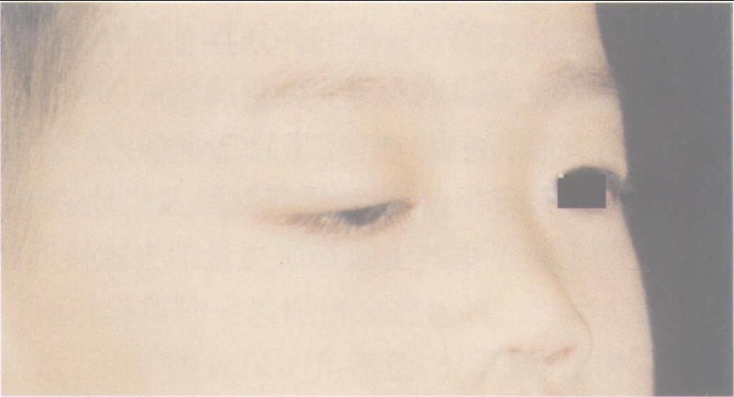 2.4.5 瞼內(nèi)翻