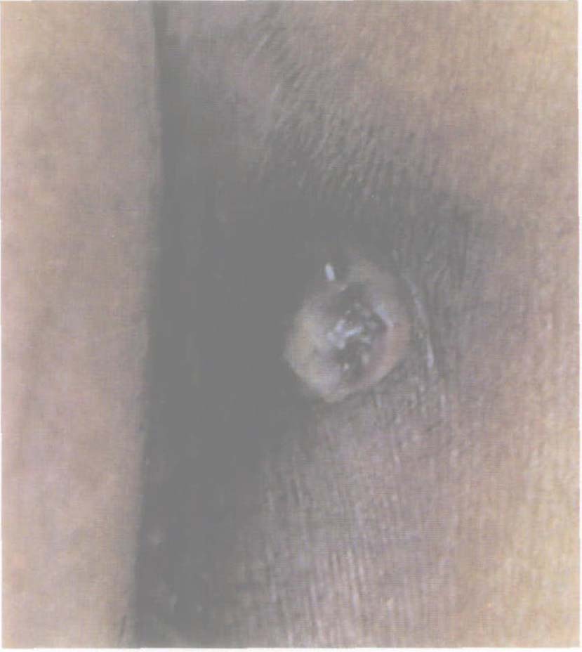 1 肛門周圍皮膚和肛門緣癌