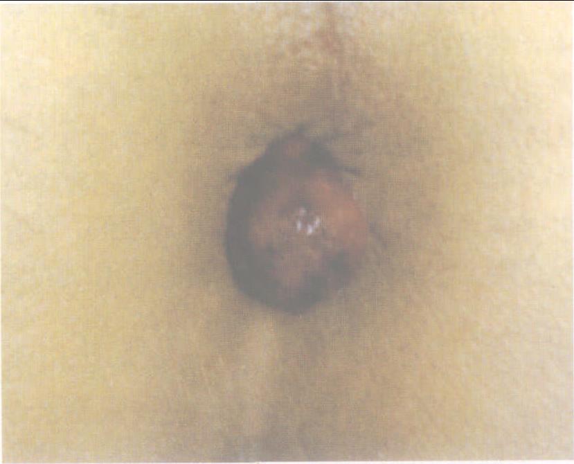 1 管狀腺瘤