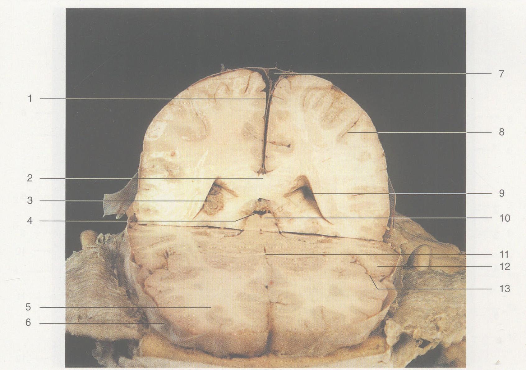 圖2—20 大腦內(nèi)部結(jié)構(gòu)